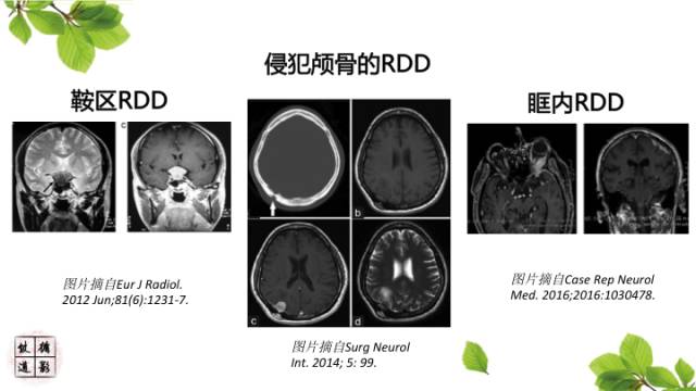【病例】中枢神经系统窦组织细胞增生症RDD一例 【病例】中枢神经系统窦组织细胞增生症RDD一例