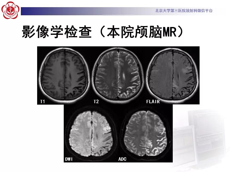 【病例】线粒体脑肌病1例MR影像表现
