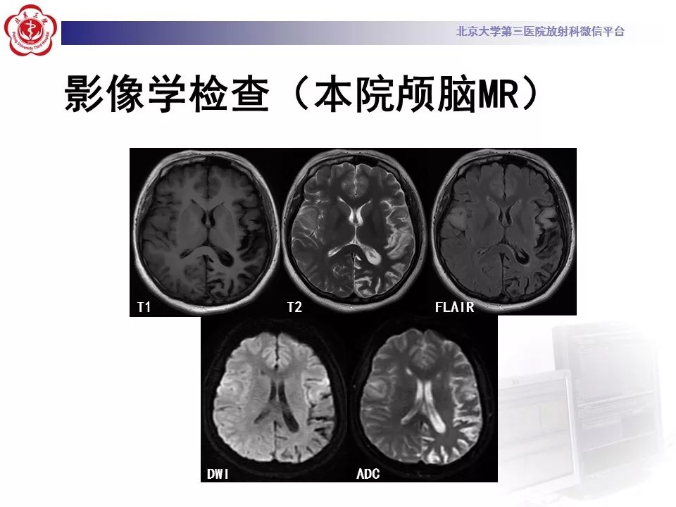 【病例】线粒体脑肌病1例MR影像表现