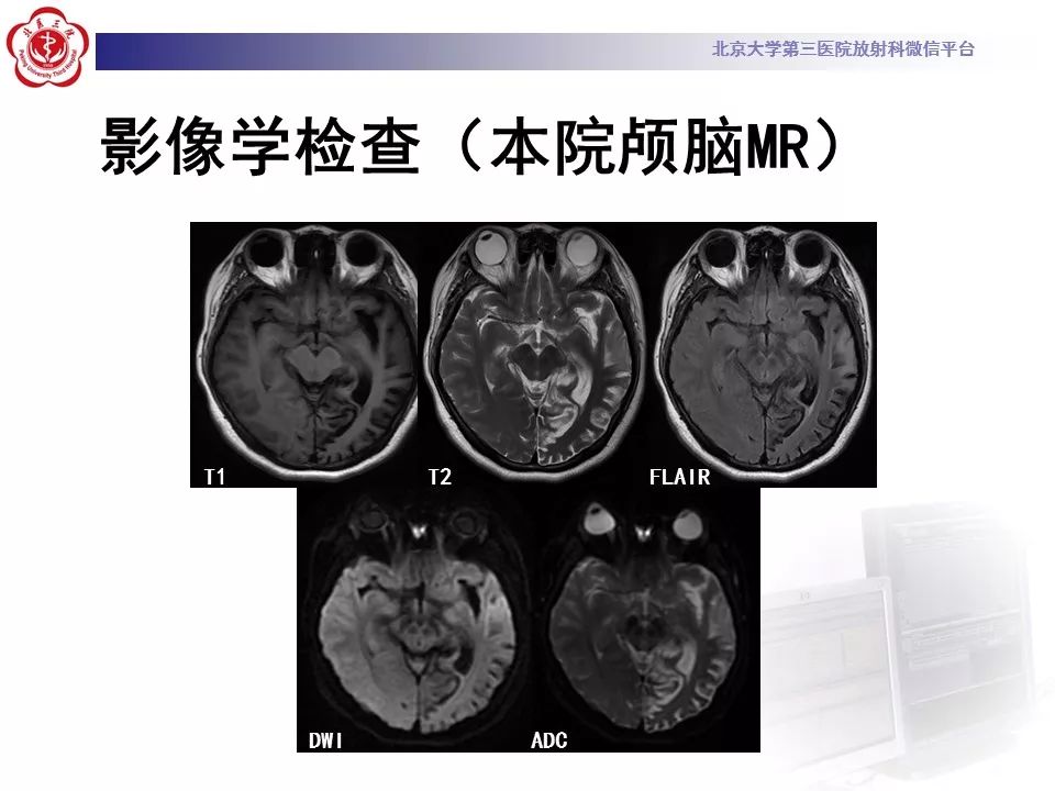 【病例】线粒体脑肌病1例MR影像表现