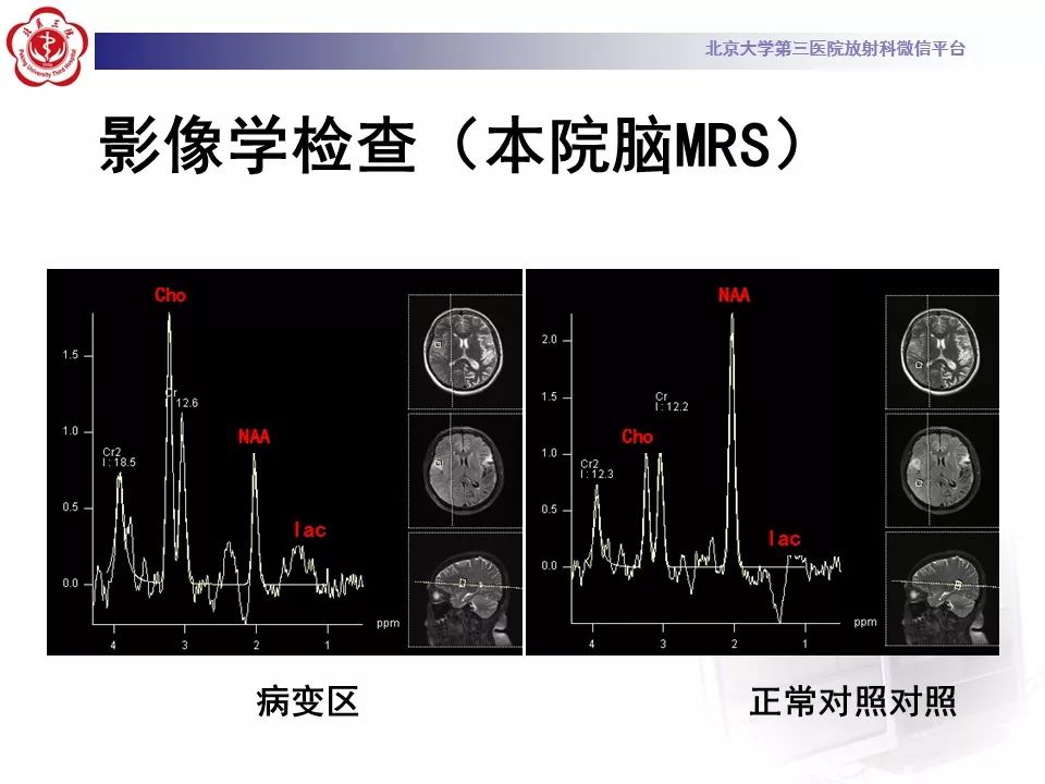 【病例】线粒体脑肌病1例MR影像表现