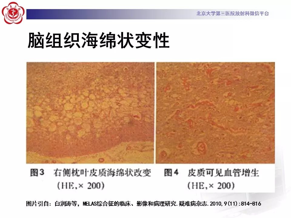 【病例】线粒体脑肌病1例MR影像表现