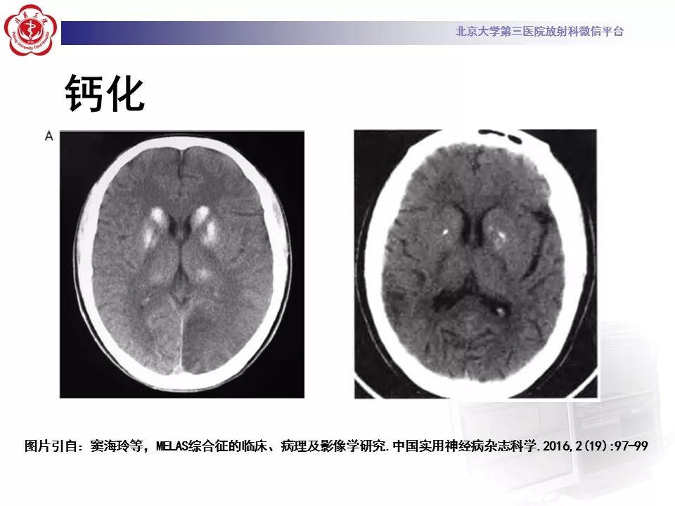 【病例】线粒体脑肌病1例MR影像表现