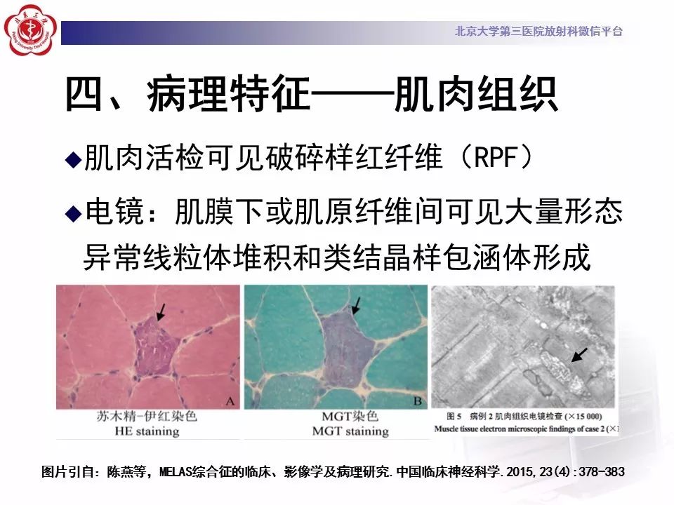 【病例】线粒体脑肌病1例MR影像表现