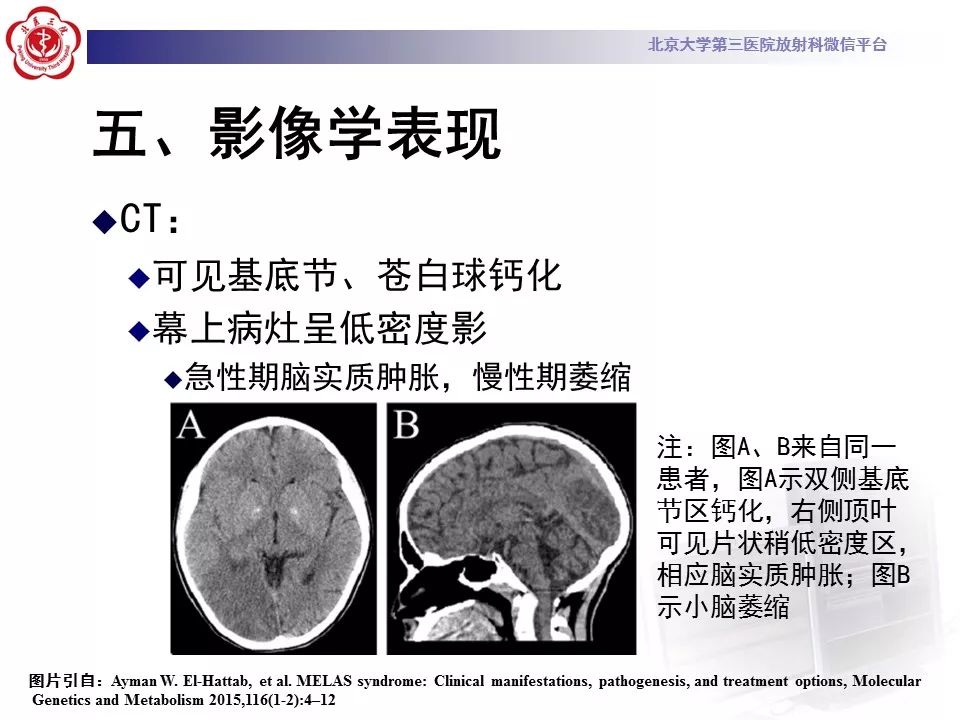 【病例】线粒体脑肌病1例MR影像表现