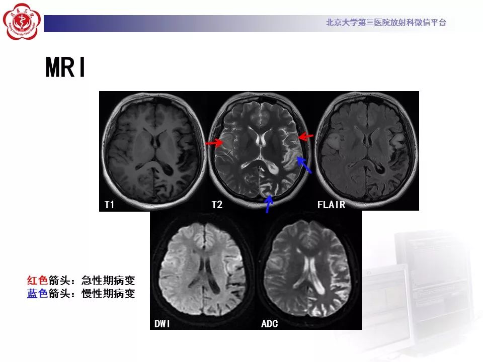 【病例】线粒体脑肌病1例MR影像表现