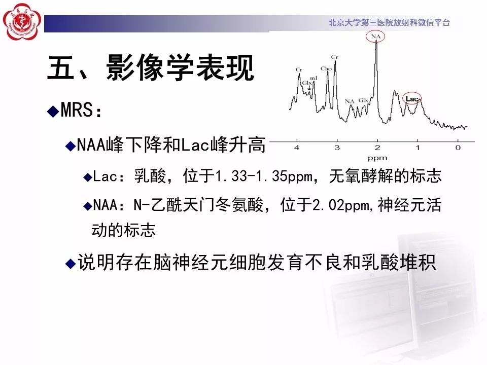 【病例】线粒体脑肌病1例MR影像表现