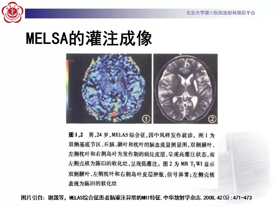 【病例】线粒体脑肌病1例MR影像表现