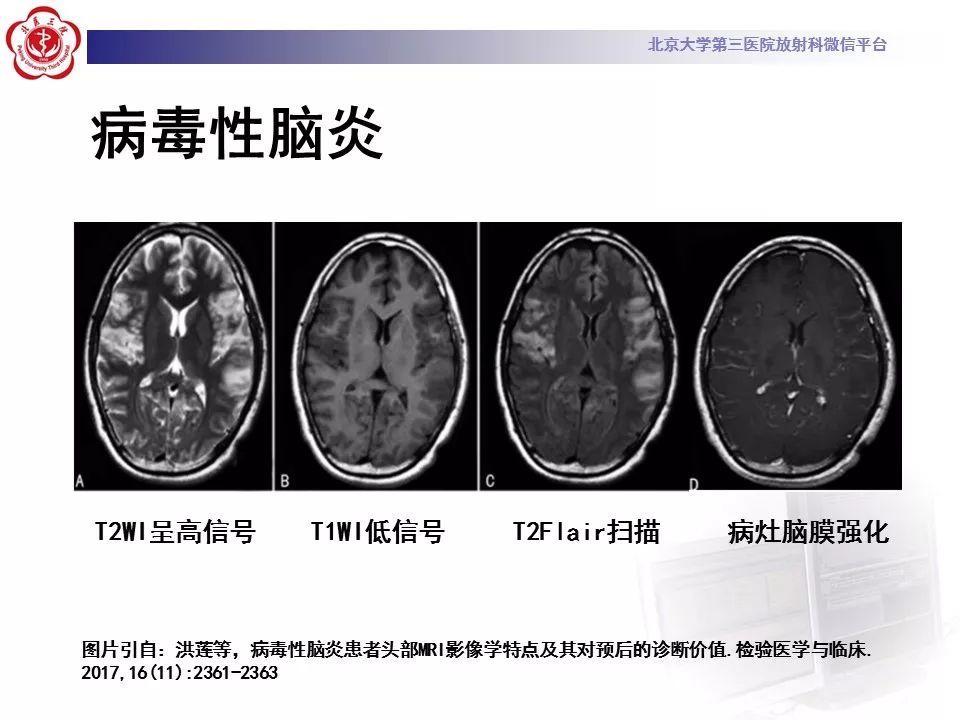 【病例】线粒体脑肌病1例MR影像表现
