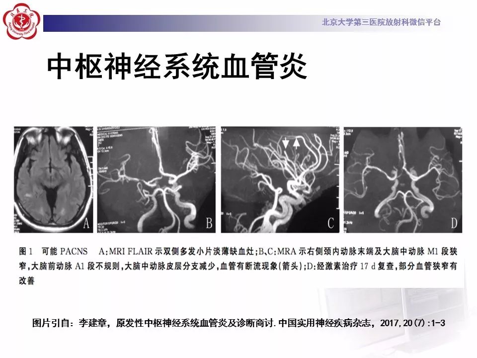 【病例】线粒体脑肌病1例MR影像表现