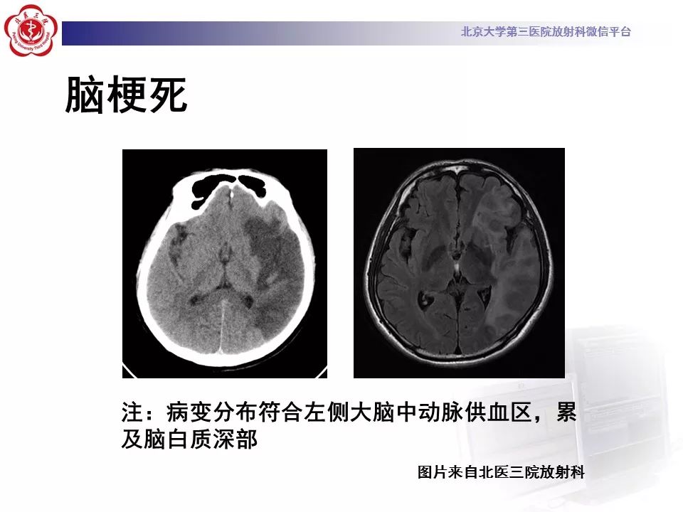 【病例】线粒体脑肌病1例MR影像表现