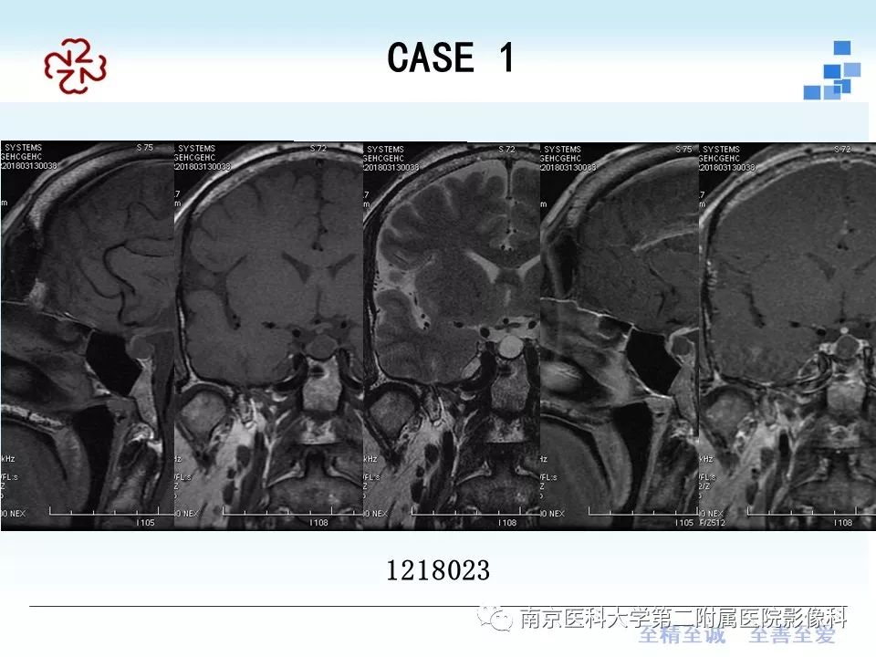 【PPT】垂体Rathke囊肿MRI表现