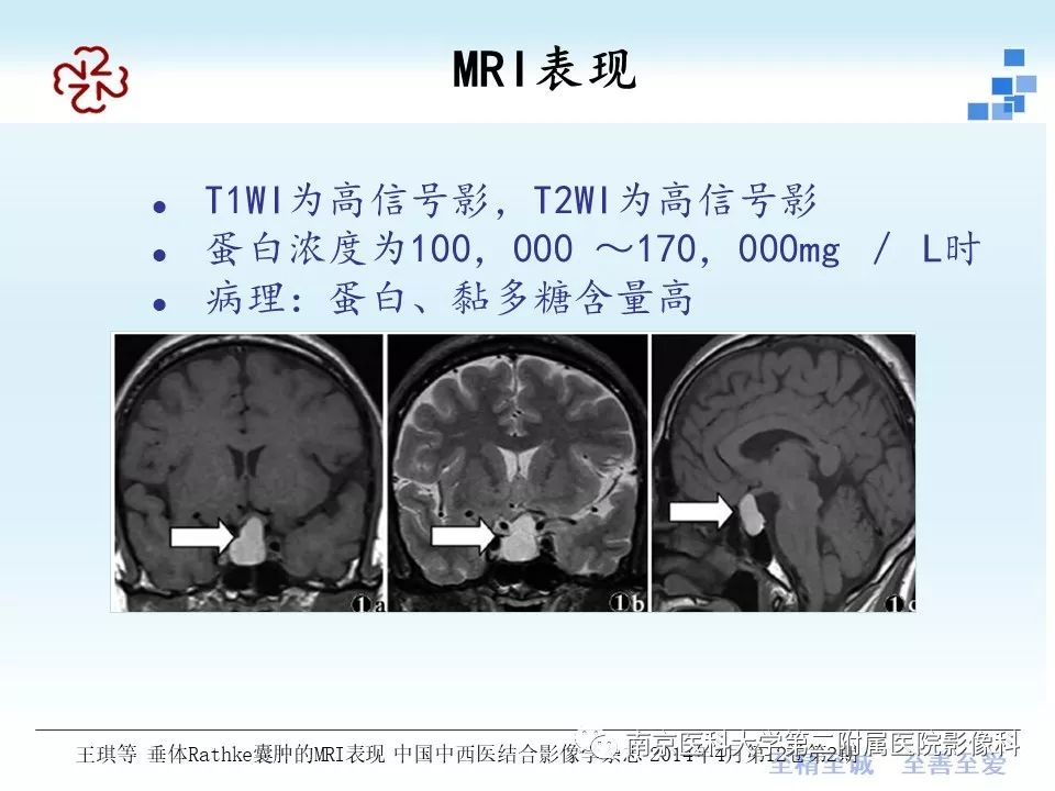 【PPT】垂体Rathke囊肿MRI表现