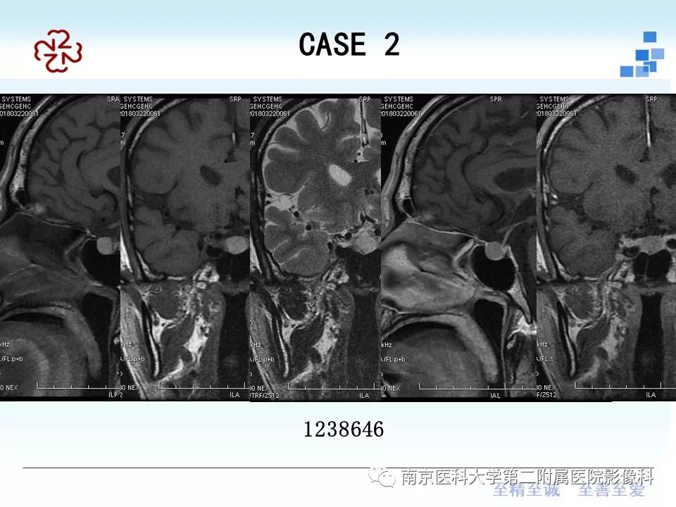 【PPT】垂体Rathke囊肿MRI表现