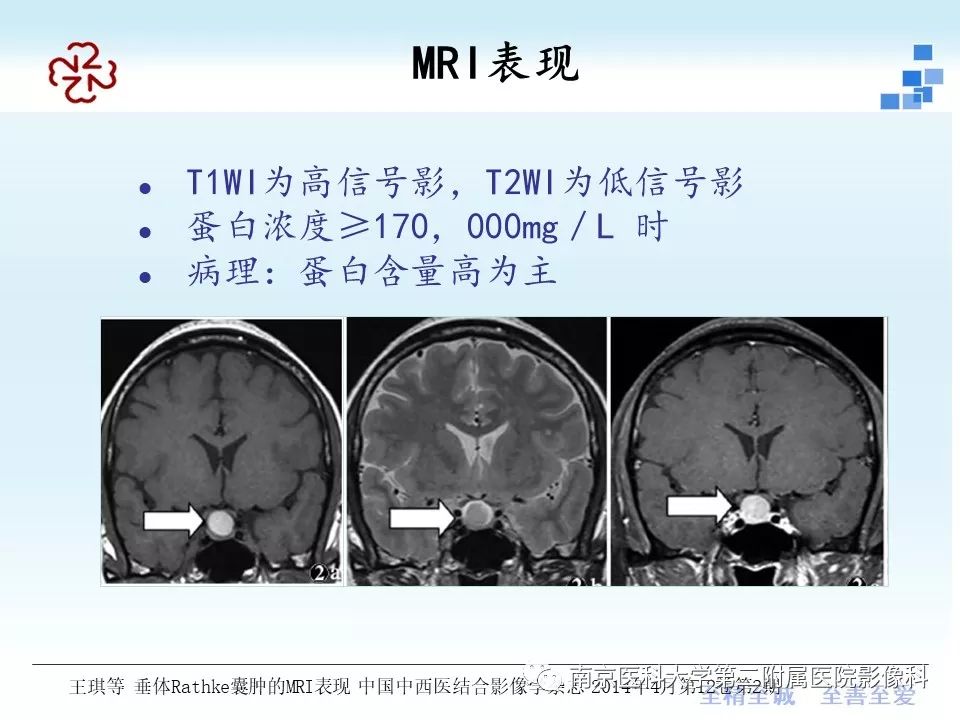 【PPT】垂体Rathke囊肿MRI表现