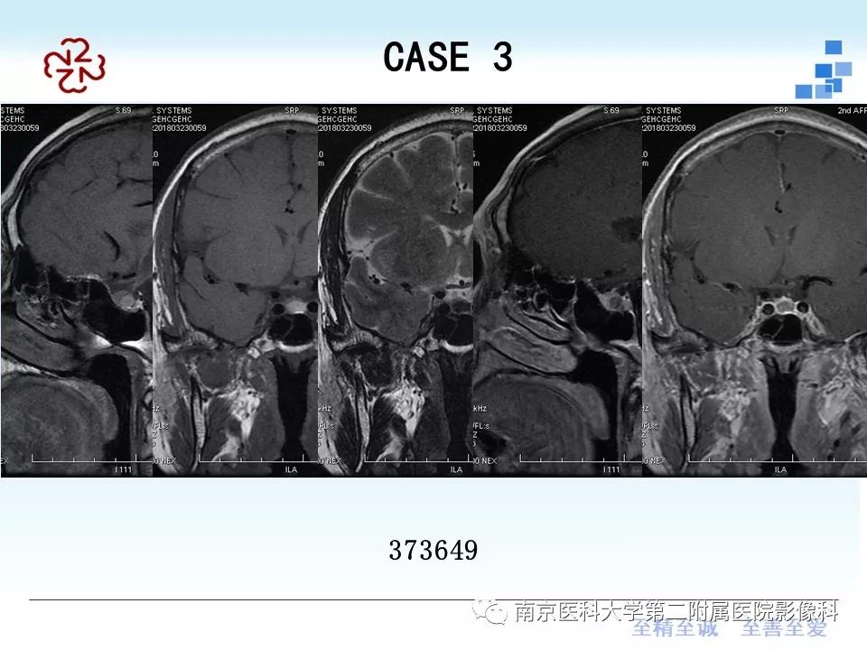 【PPT】垂体Rathke囊肿MRI表现