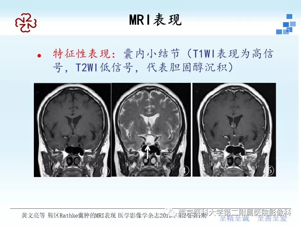【PPT】垂体Rathke囊肿MRI表现