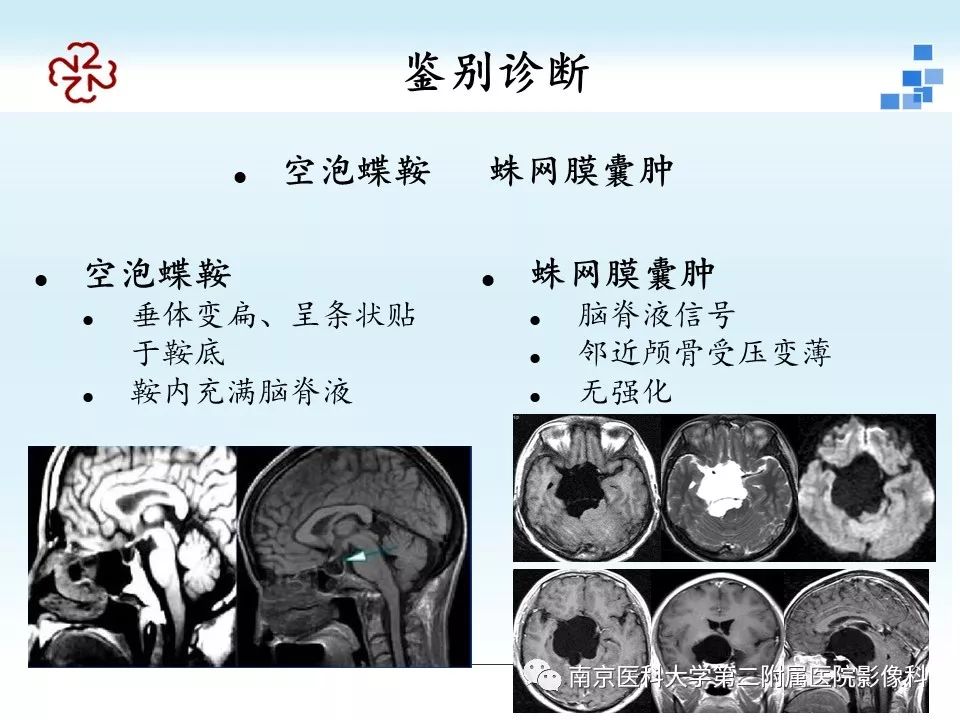 【PPT】垂体Rathke囊肿MRI表现