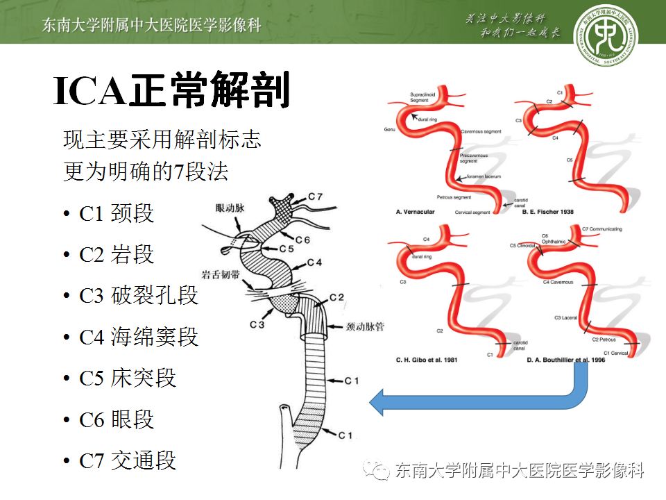 【病例】永存三叉动脉1例CT及DSA