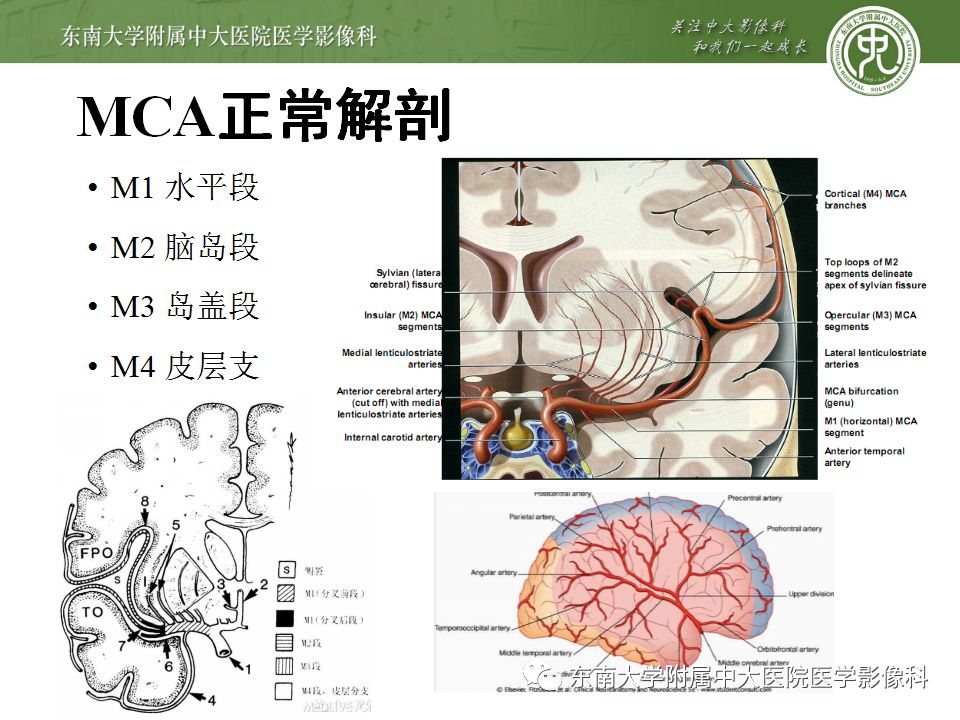 【病例】永存三叉动脉1例CT及DSA