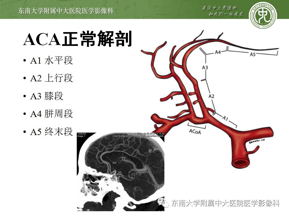 【病例】永存三叉动脉1例CT及DSA