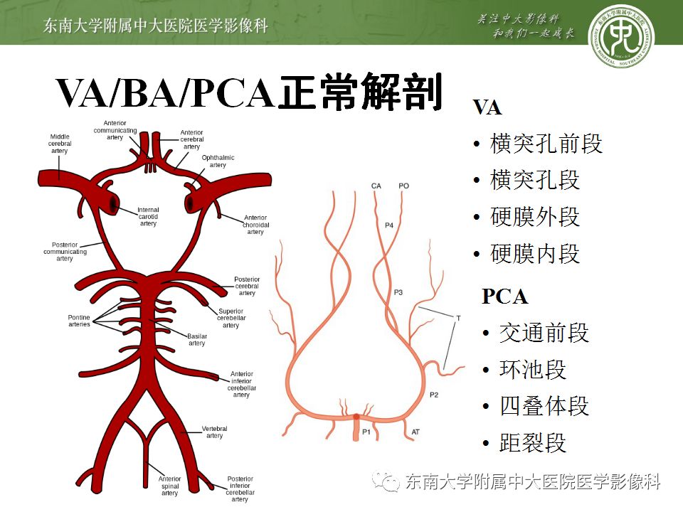 【病例】永存三叉动脉1例CT及DSA