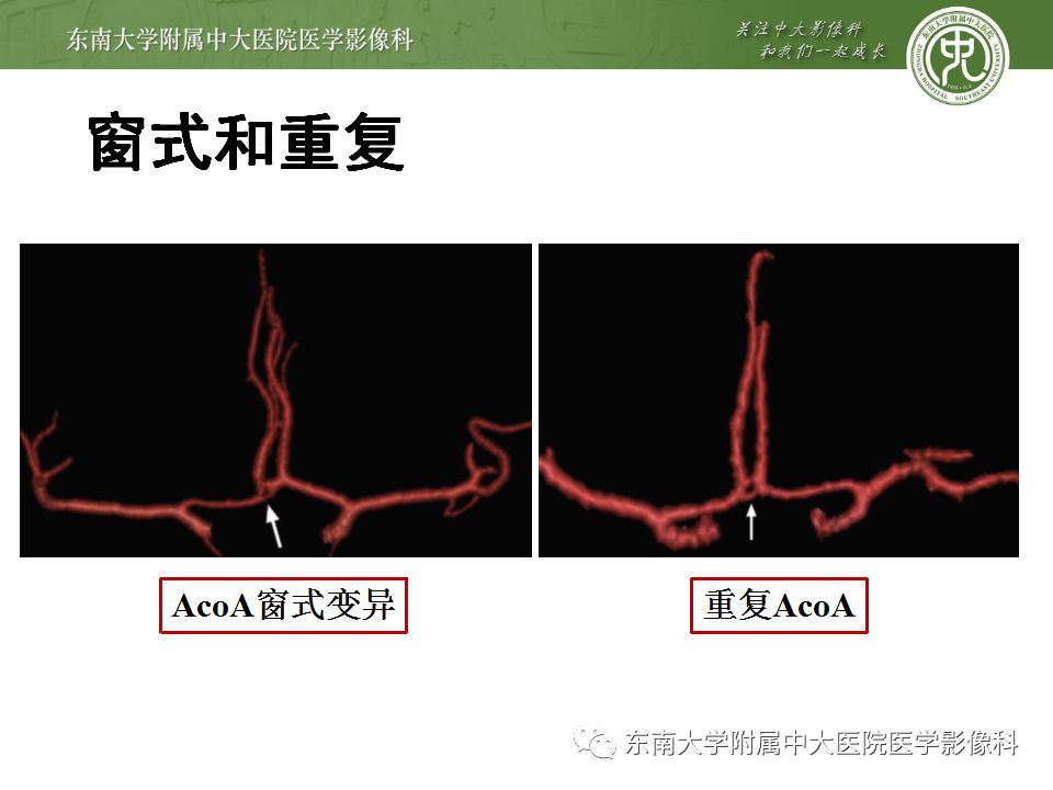 【病例】永存三叉动脉1例CT及DSA