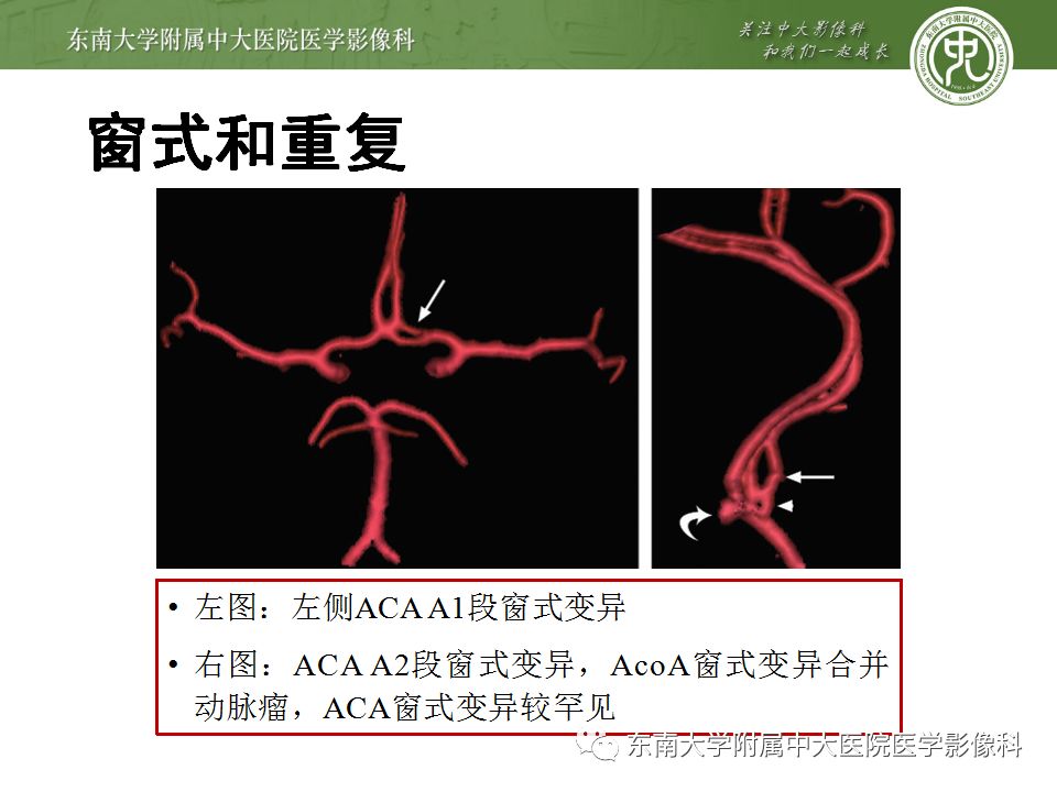 【病例】永存三叉动脉1例CT及DSA