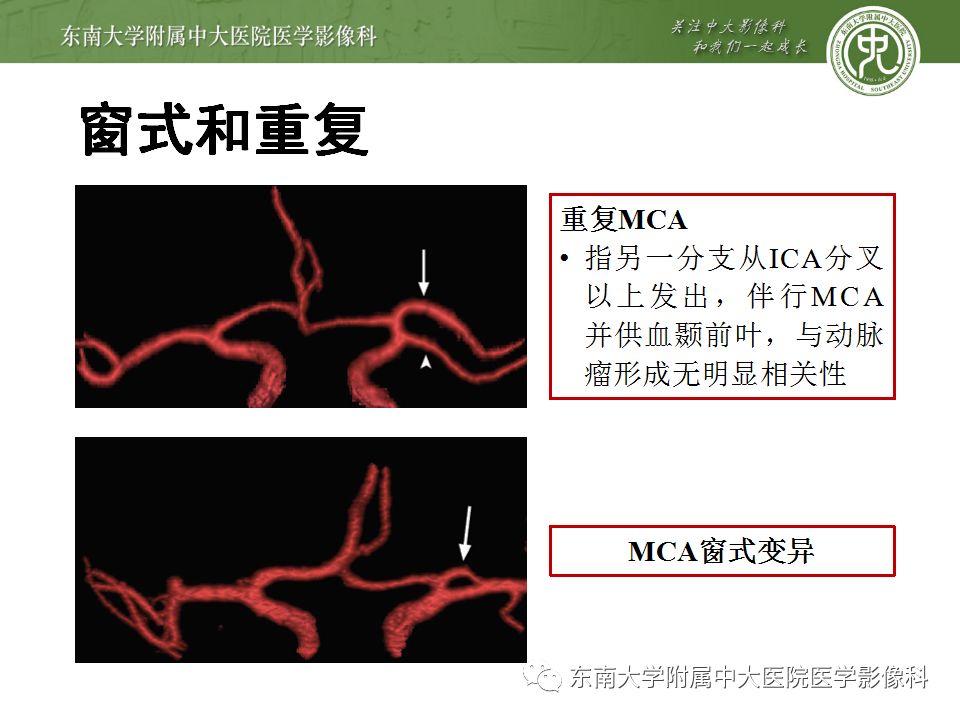 【病例】永存三叉动脉1例CT及DSA