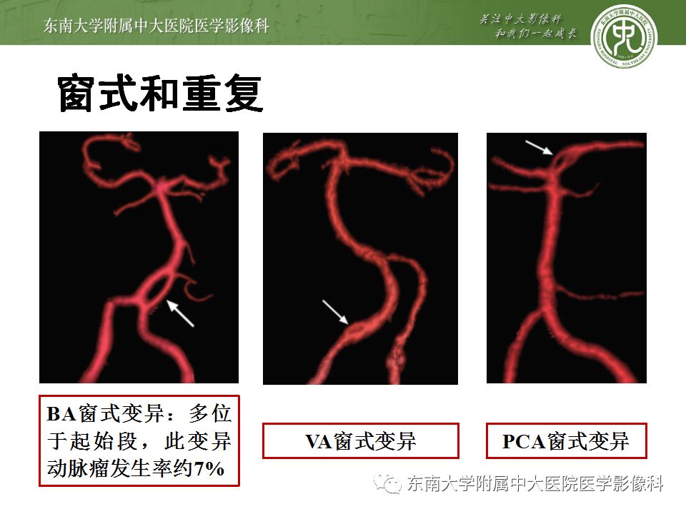 【病例】永存三叉动脉1例CT及DSA