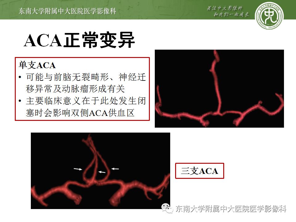 【病例】永存三叉动脉1例CT及DSA