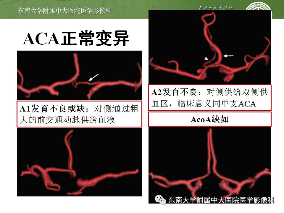 【病例】永存三叉动脉1例CT及DSA