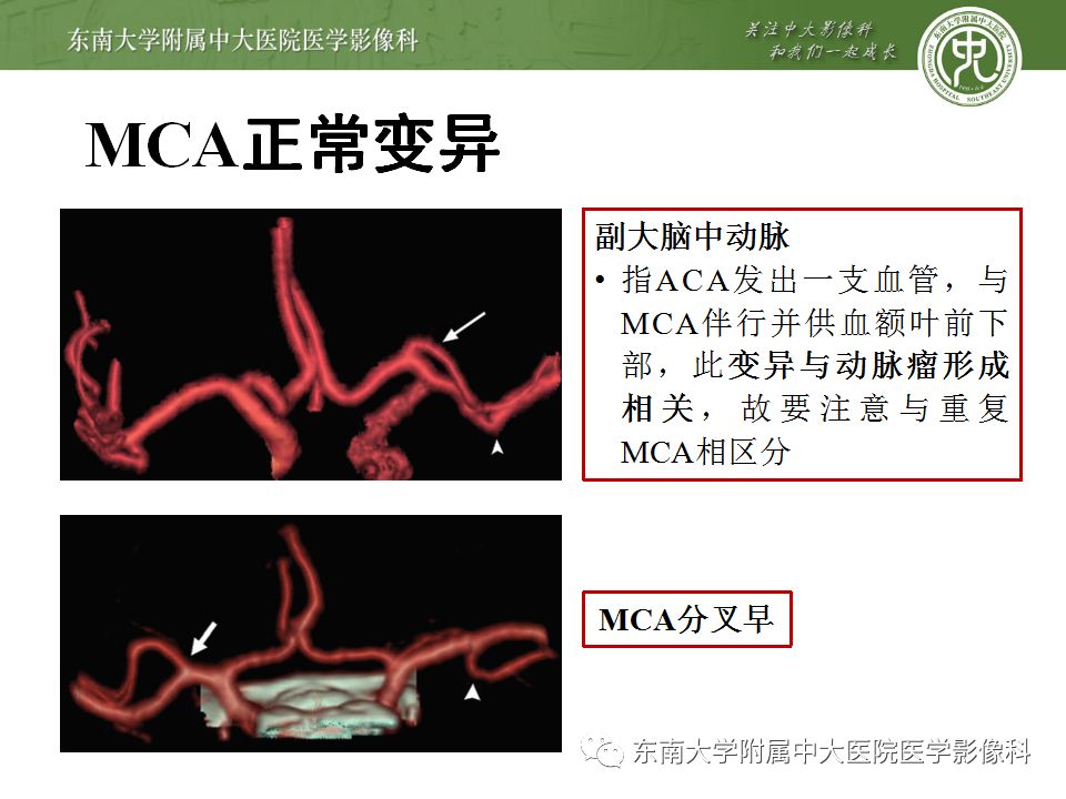 【病例】永存三叉动脉1例CT及DSA