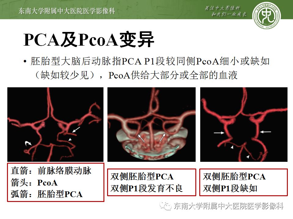 【病例】永存三叉动脉1例CT及DSA
