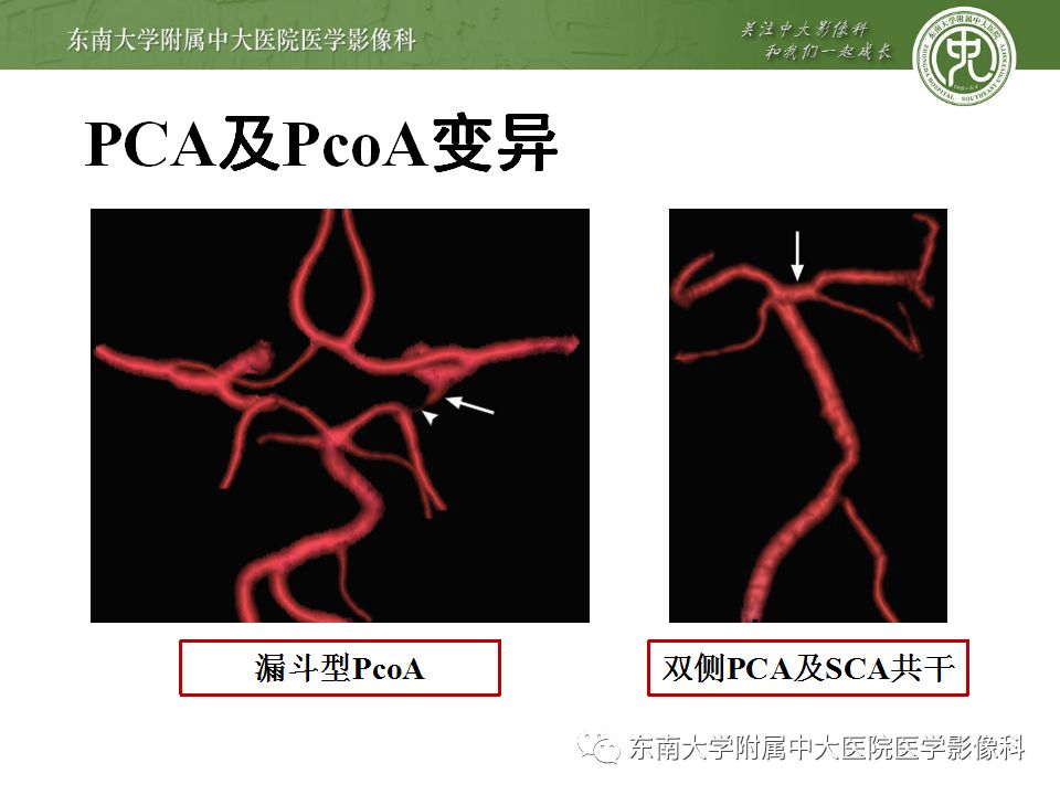 【病例】永存三叉动脉1例CT及DSA
