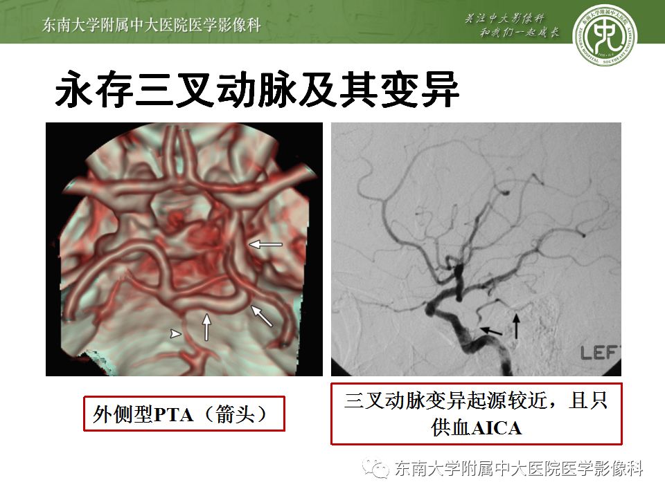 【病例】永存三叉动脉1例CT及DSA