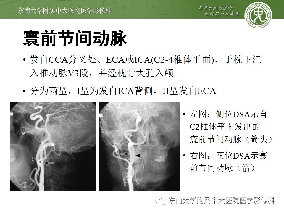 【病例】永存三叉动脉1例CT及DSA