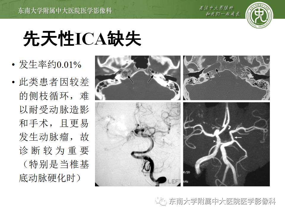 【病例】永存三叉动脉1例CT及DSA