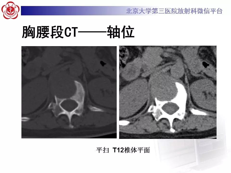 【病例】脊柱胚胎性横纹肌肉瘤1例CT及MR影像表现