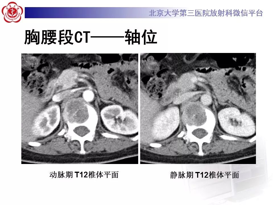 【病例】脊柱胚胎性横纹肌肉瘤1例CT及MR影像表现