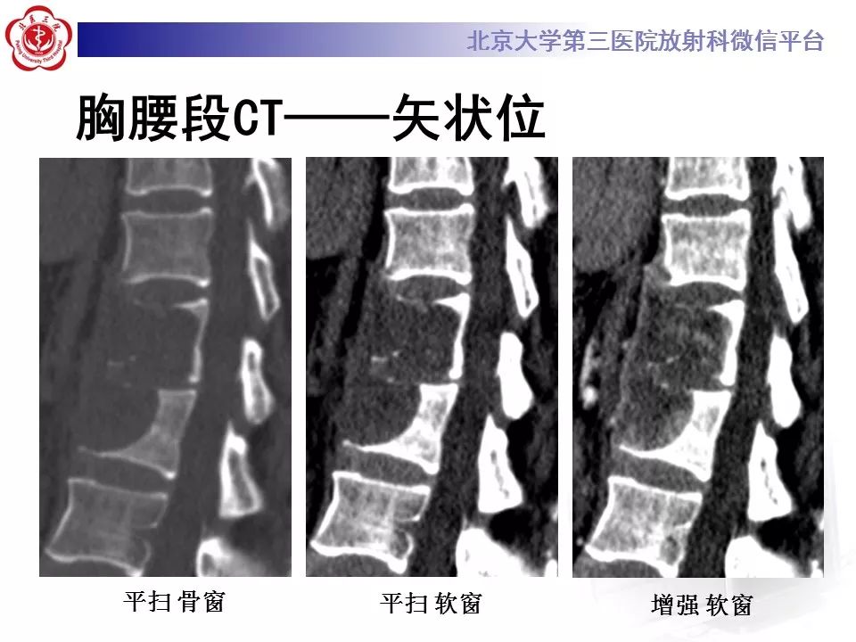 【病例】脊柱胚胎性横纹肌肉瘤1例CT及MR影像表现