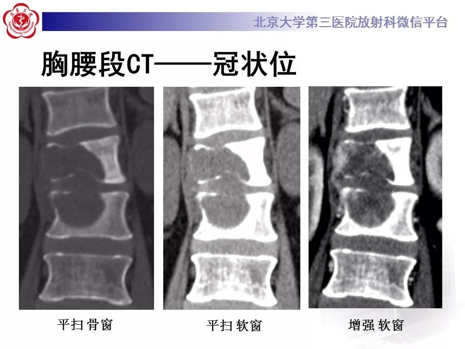 【病例】脊柱胚胎性横纹肌肉瘤1例CT及MR影像表现