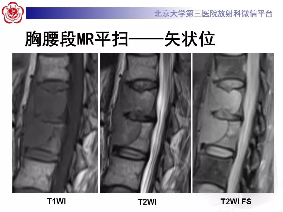 【病例】脊柱胚胎性横纹肌肉瘤1例CT及MR影像表现