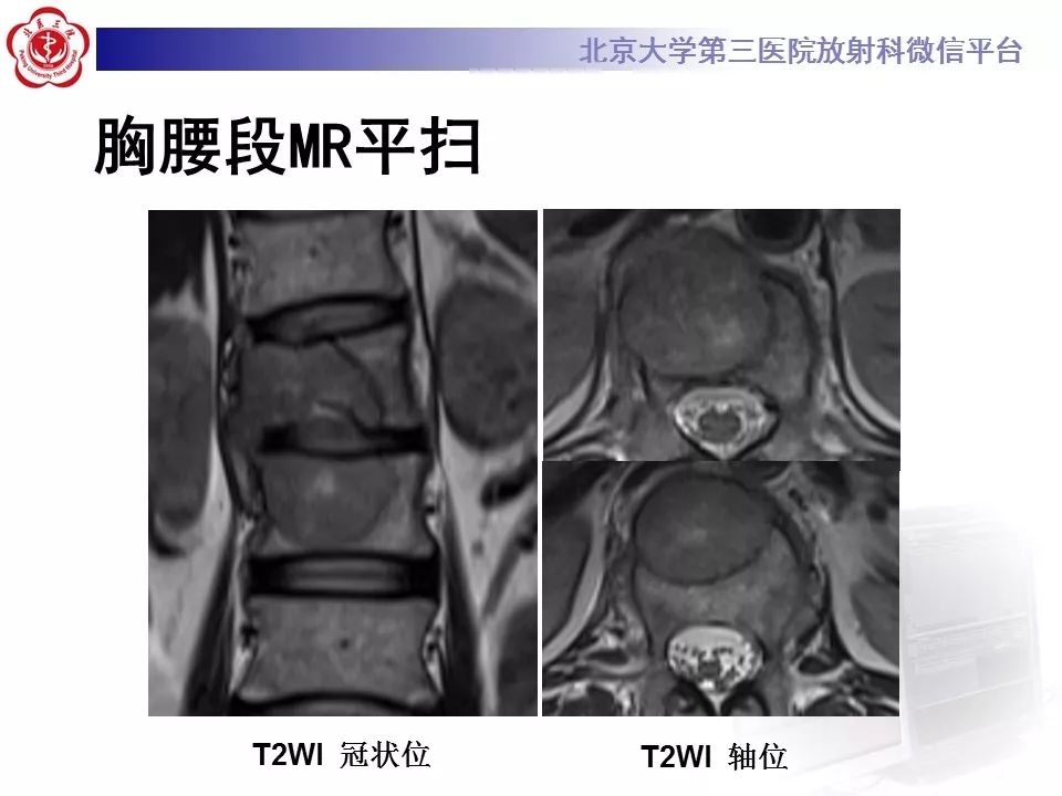 【病例】脊柱胚胎性横纹肌肉瘤1例CT及MR影像表现
