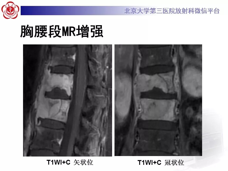 【病例】脊柱胚胎性横纹肌肉瘤1例CT及MR影像表现