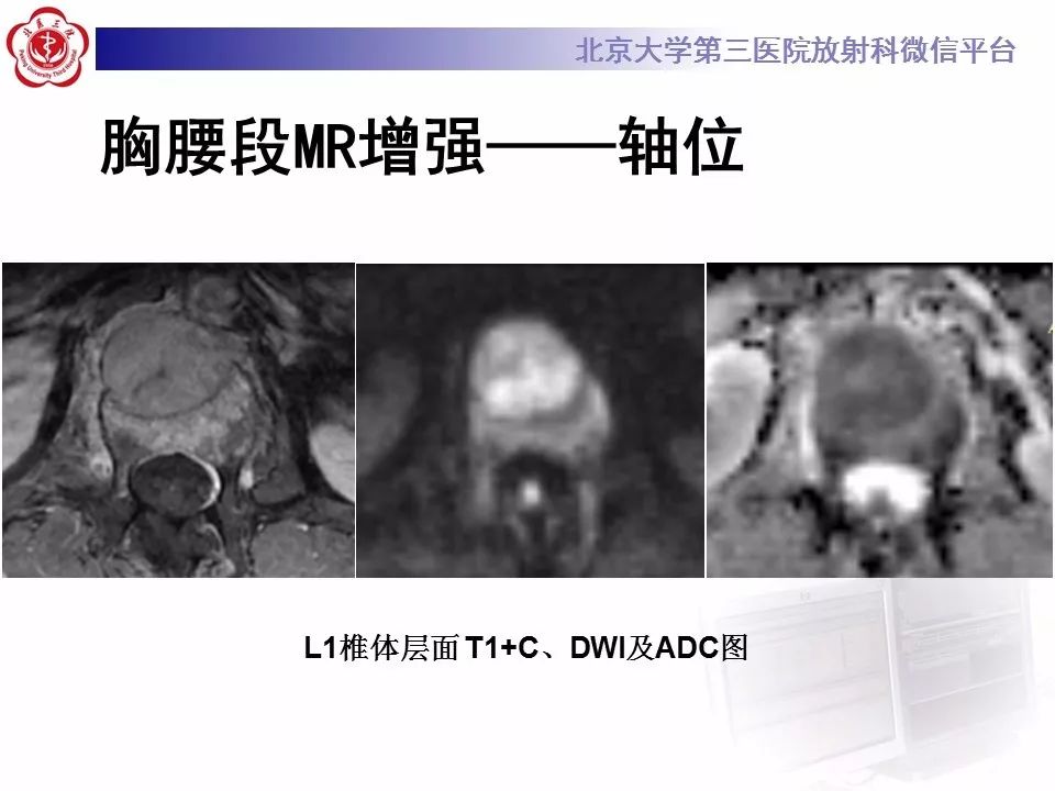 【病例】脊柱胚胎性横纹肌肉瘤1例CT及MR影像表现