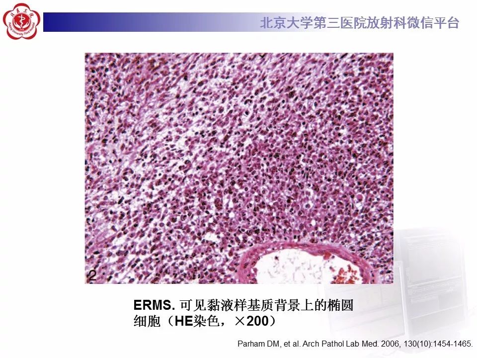 【病例】脊柱胚胎性横纹肌肉瘤1例CT及MR影像表现