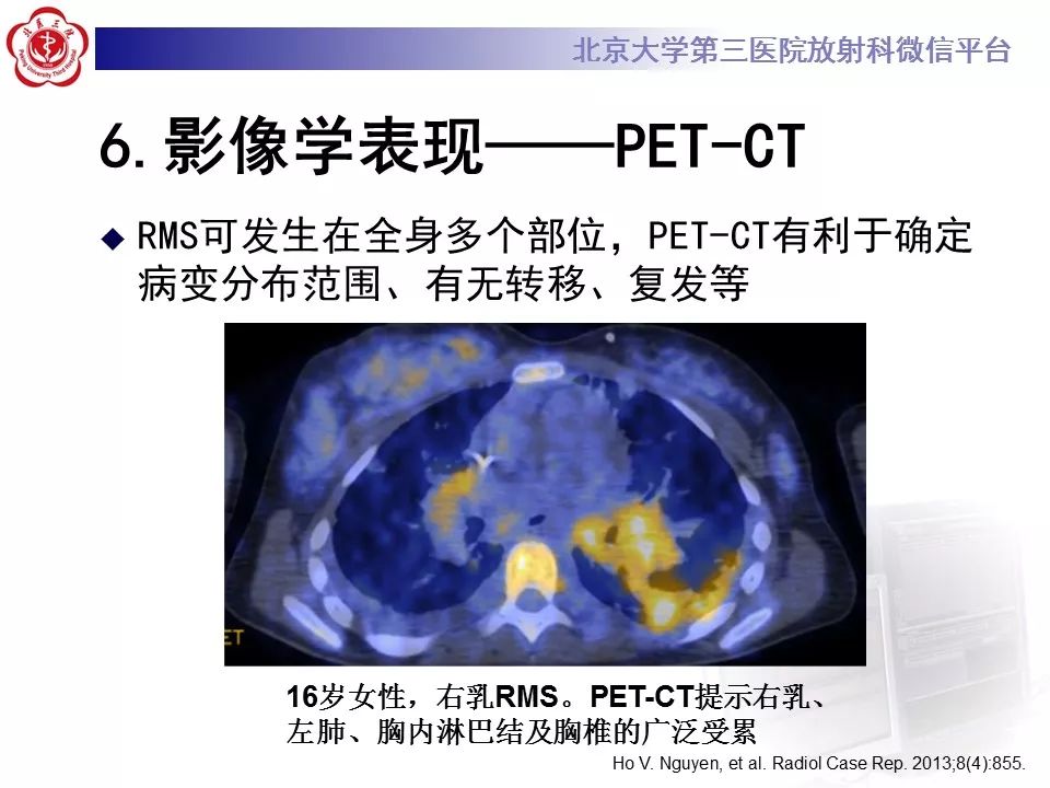 【病例】脊柱胚胎性横纹肌肉瘤1例CT及MR影像表现