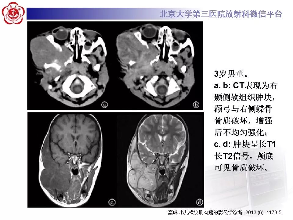 【病例】脊柱胚胎性横纹肌肉瘤1例CT及MR影像表现