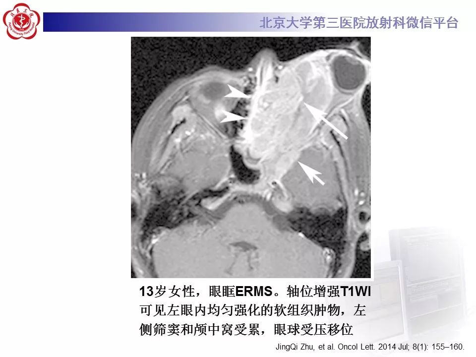 【病例】脊柱胚胎性横纹肌肉瘤1例CT及MR影像表现